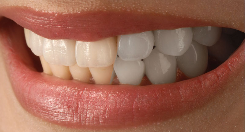 teeth whitening before after